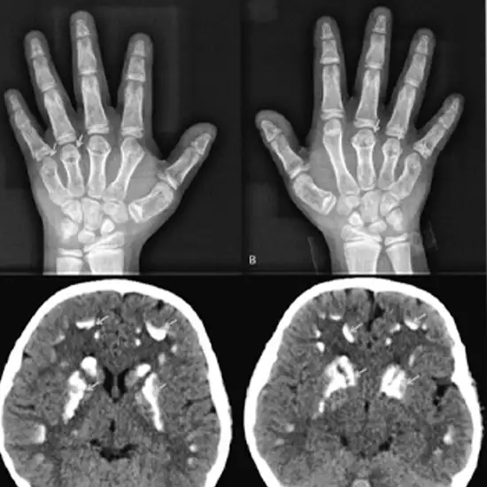 CT Hand Angiography